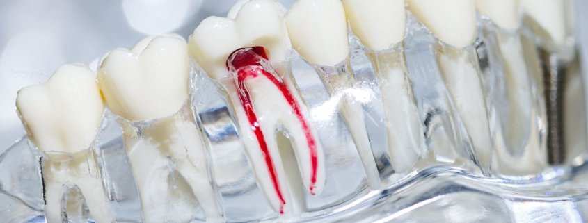 Devitalizzazione dente